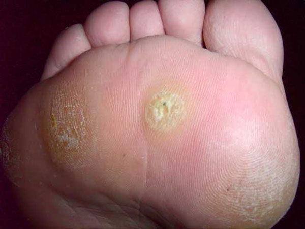 common wart on foot. including common warts,