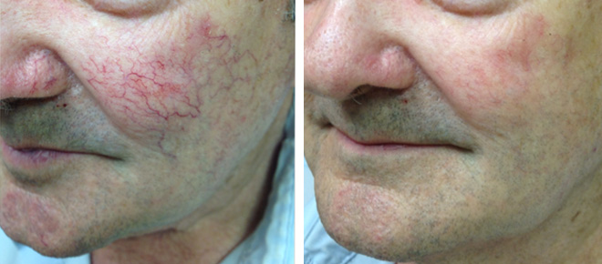 Before and After pictures of recent laser procedures performed at Winston Salem Dermatology & Surgery Center