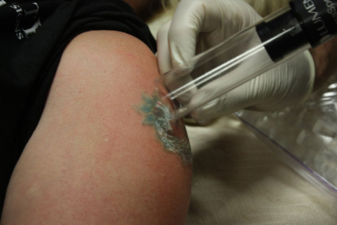 Tattoo Removal Using The Safe and Effective Versapulse Laser