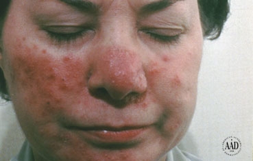 Rosacea is a common skin condition that causes redness, red bumps, pustules, swelling, and broken blood vessels on the face