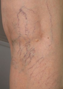 Spider veins are small, enlarged, superficial blood vessels that appear red, blue, or purple, and commonly occur on the legs.