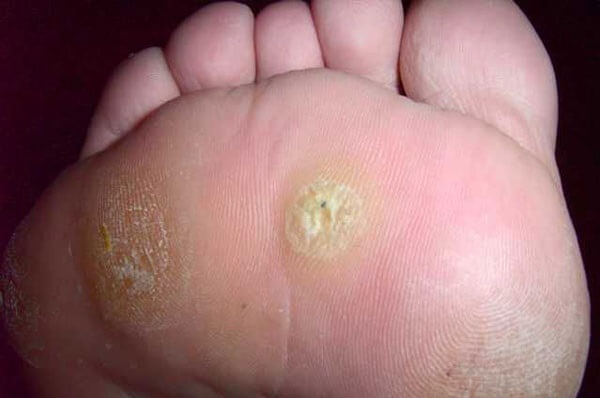 wart foot hand benign cancer of the bladder