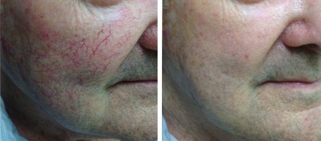 Before and After pictures of recent laser procedures performed at Winston Salem Dermatology & Surgery Center