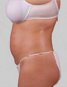Exilis belly after the procedure