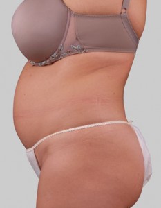 EXILIS belly before the procedure