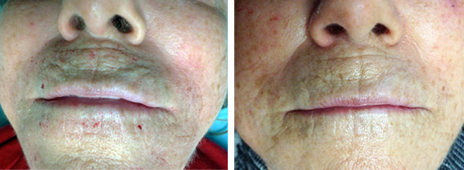 Microneedling, 1 treatment, before and after.