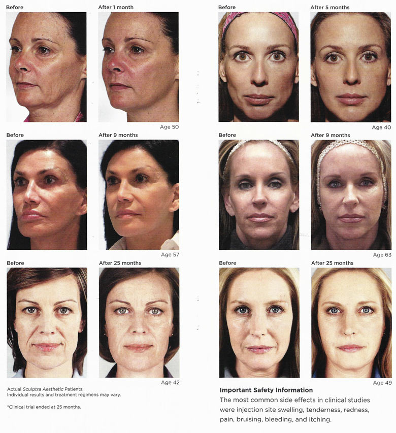 Sculptra780w-before-after