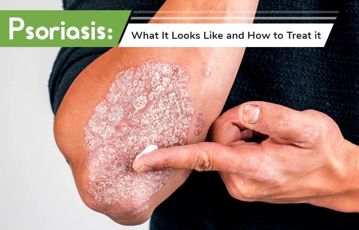 Psoriasis What It Looks Like and How to Treat it