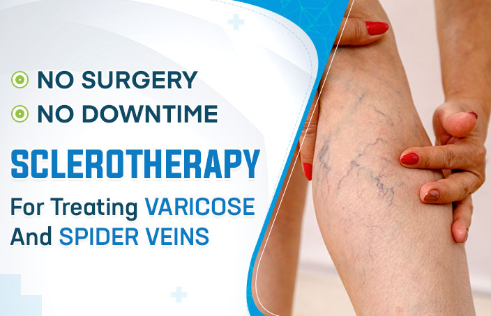 Sclerotherapy for Treating Varicose and Spider Veins