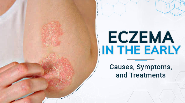 Eczema in the Early Years: Causes, Symptoms, and Treatments