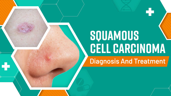 Squamous-Cell-Carcinoma-Diagnosis-and-Treatment