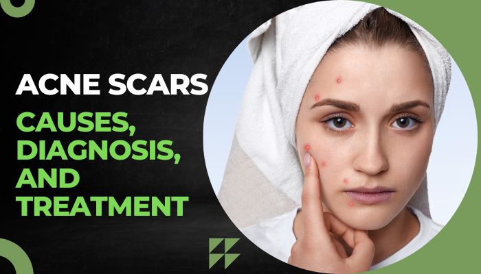 Acne Scars- Causes, Diagnosis, and Treatment