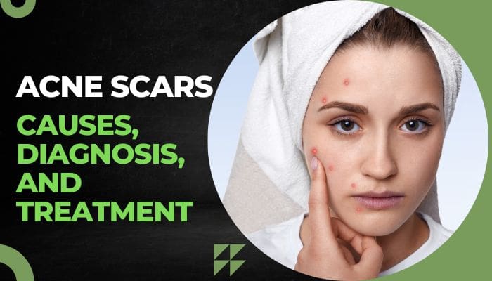 acne causes