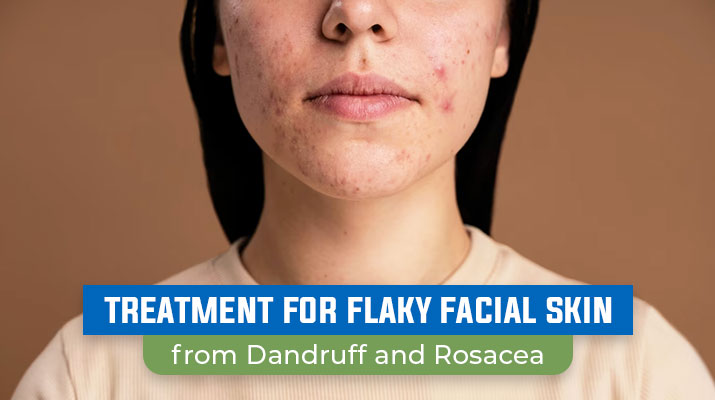 Treatment for Flaky Facial Skin from Dandruff and Rosacea